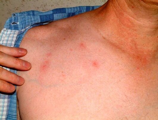 síntomas de parásitos debajo de la piel